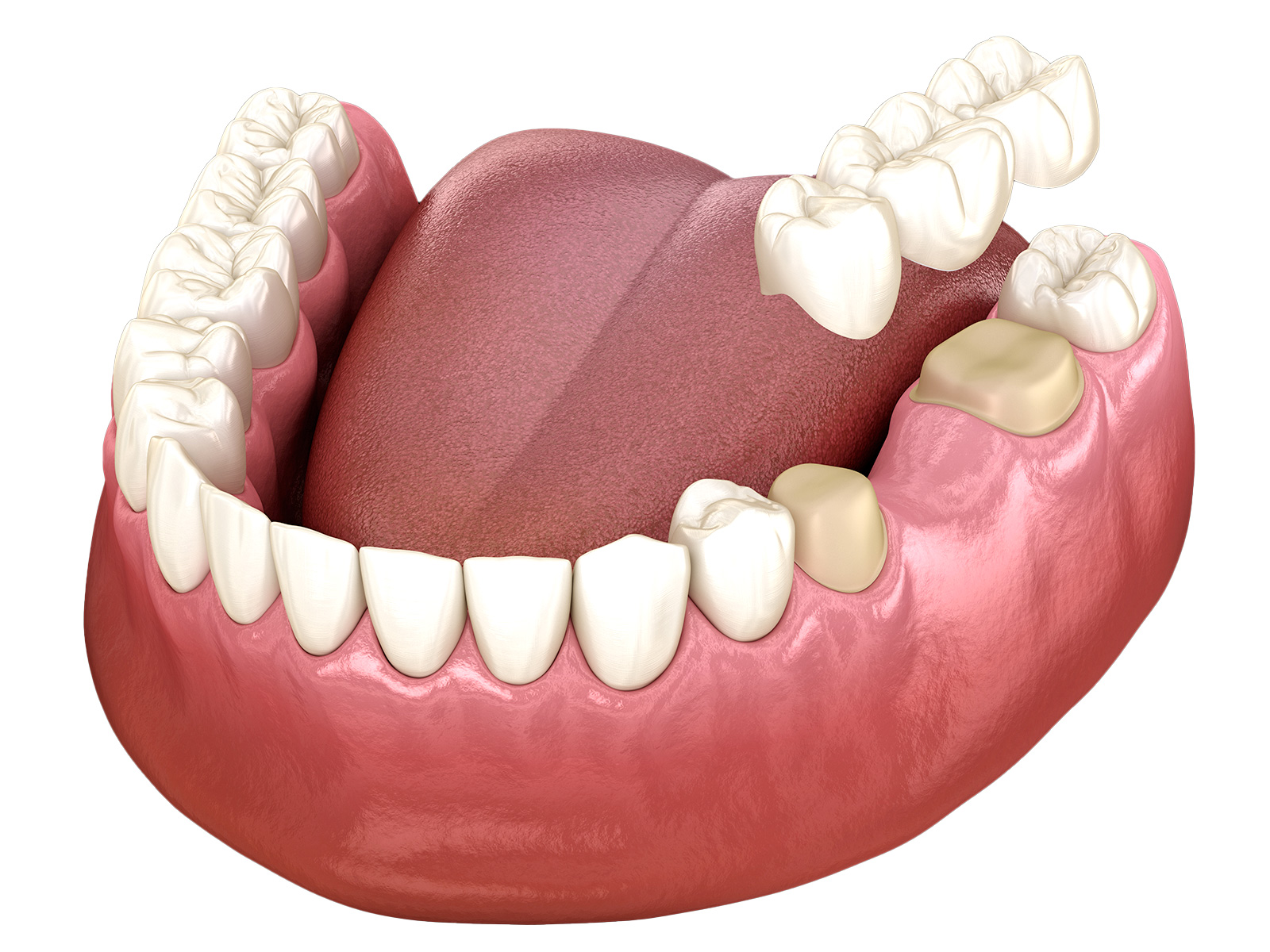 Ponte su Denti Naturali